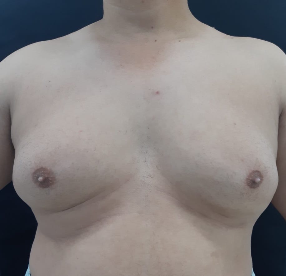 crescimento exagerado das mamas em homens - ginecomastia